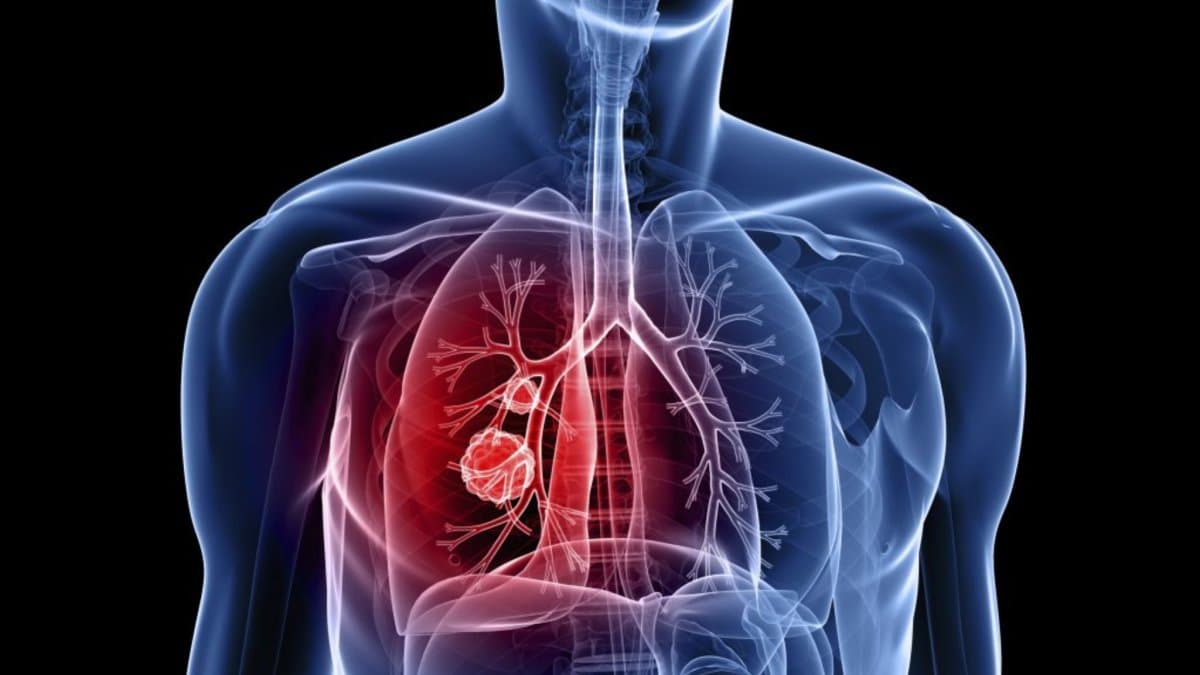 Cáncer de pulmón en RD: avanza en jóvenes y mujeres no fumadoras