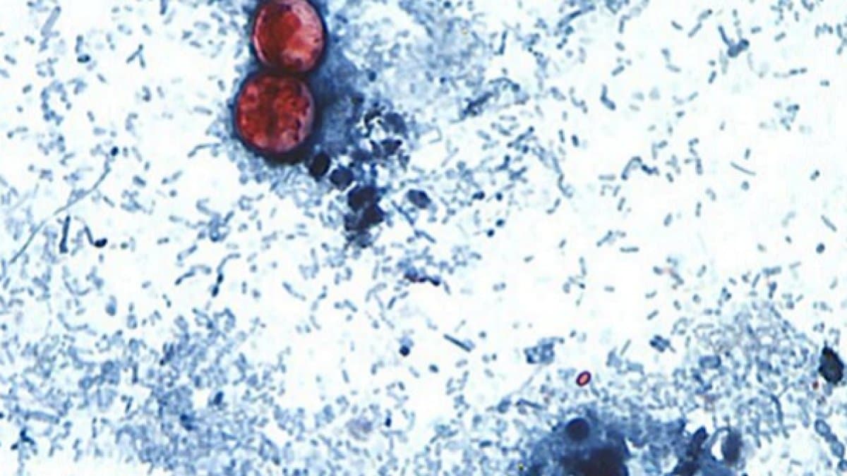 Qué es la ciclosporiasis y cuáles son los síntomas