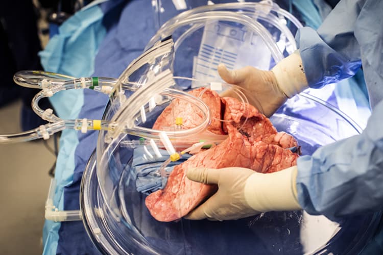 Cleveland Clinic realiza el primer trasplante de pulmón asistido por robot en EE.UU