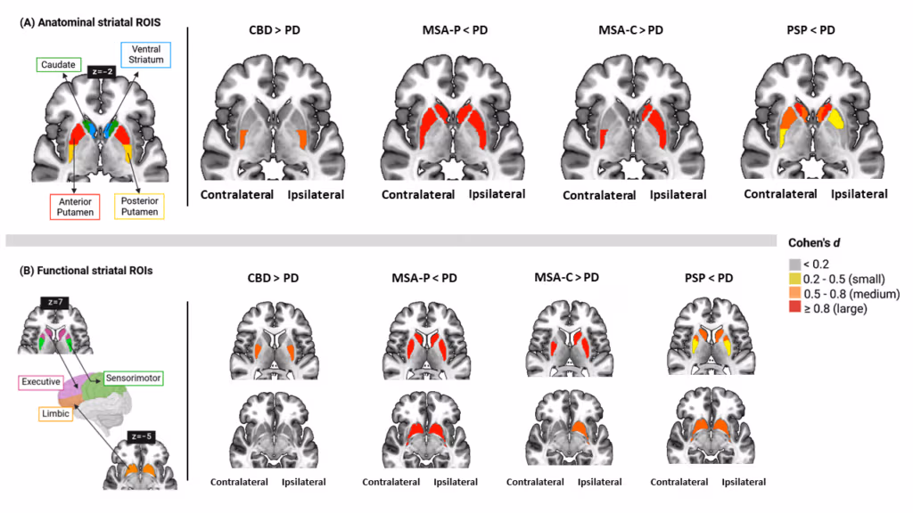 Un modelo de IA mejora el diagnóstico diferencial del párkinson al identificar patrones cerebrales específicos